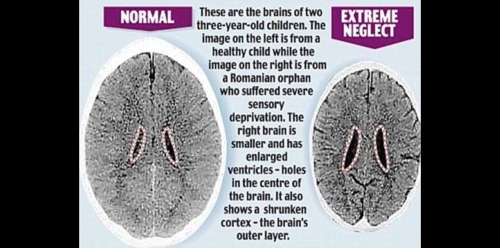 Compare healthy child's brain with the brain of the child that was heavy punished