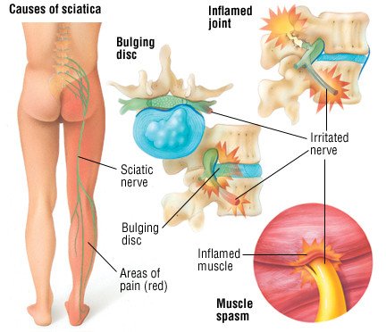 Treatment for Sciatica