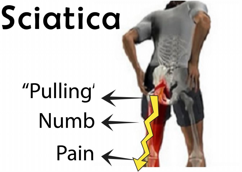 Symptoms of Sciatica