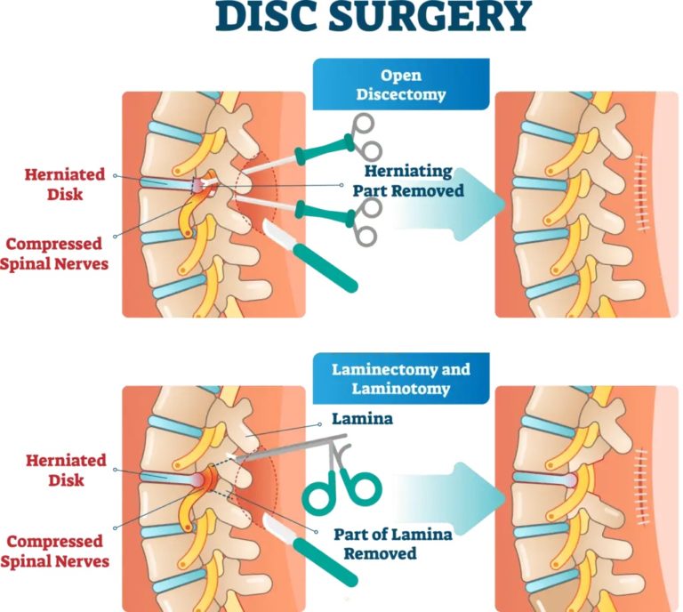 Discectomy and Laminectomy