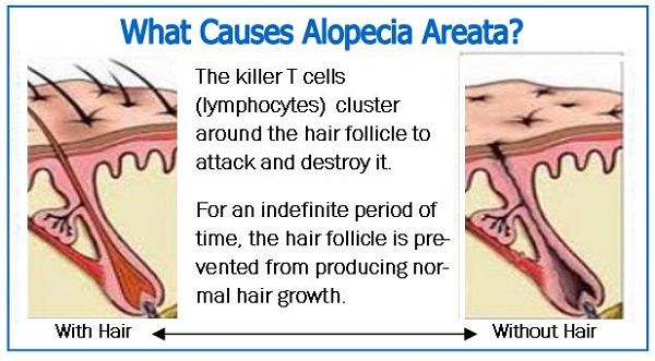 Causes of hair loss in women