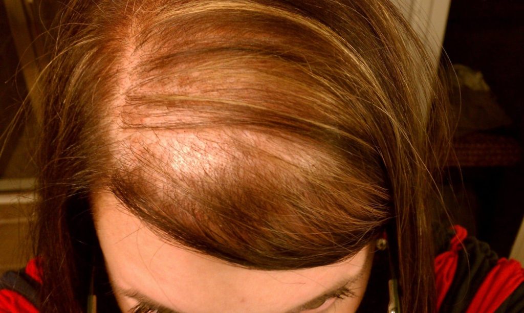 Hair loss in women
