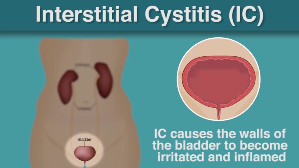 IC