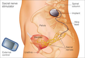 Sacral nerve stimulation for Interstitial cystitis