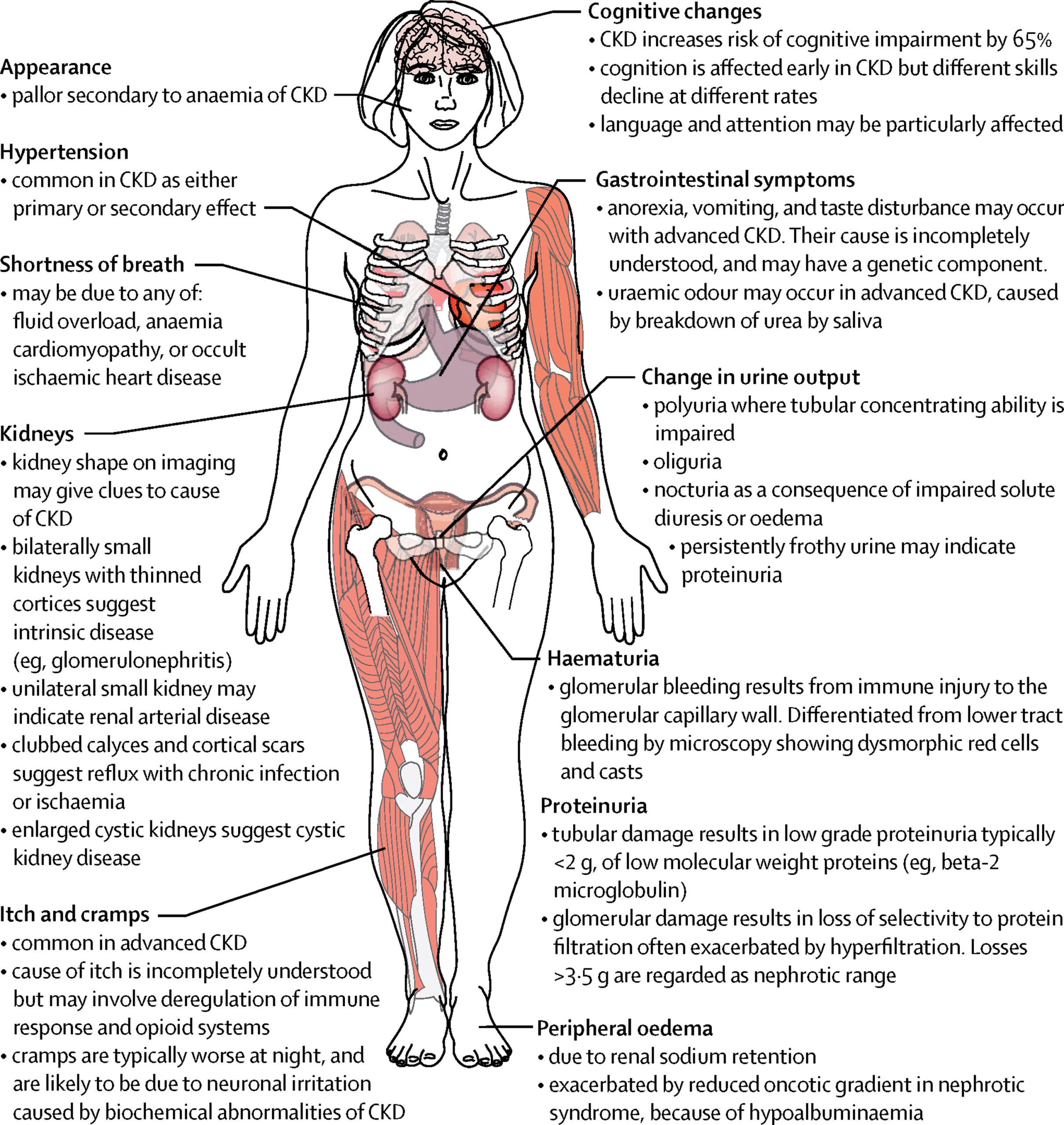 Chronic Kidney Disease