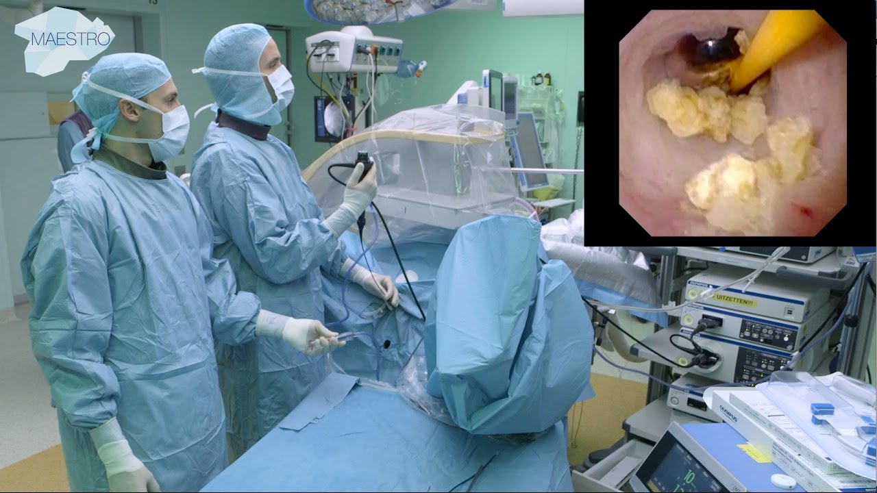 Surgery for renal calicos 
