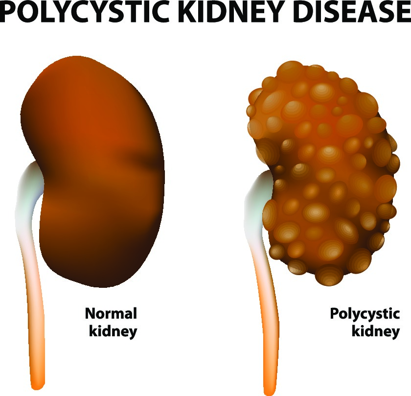 polycystic kidney