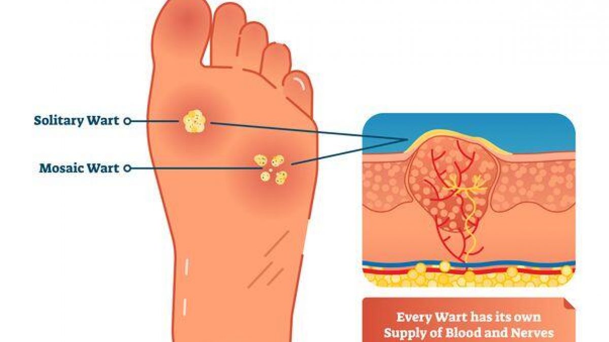 Plantar warts