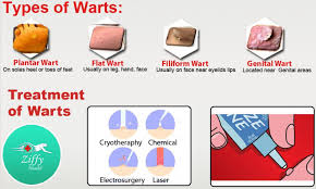 Treatment for warts