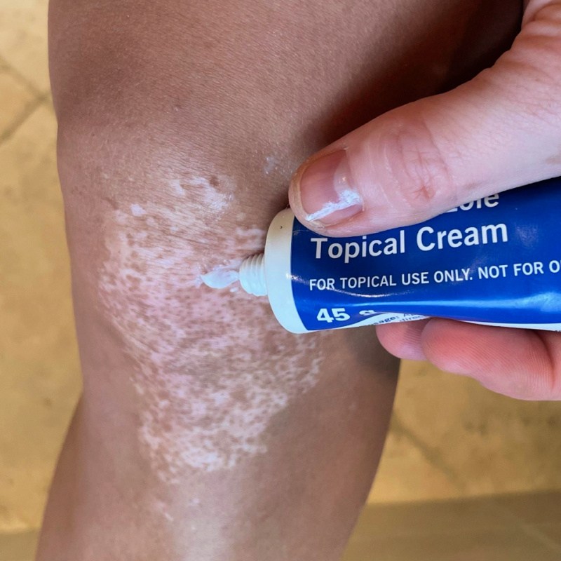 Vitiligo treatment topical cream