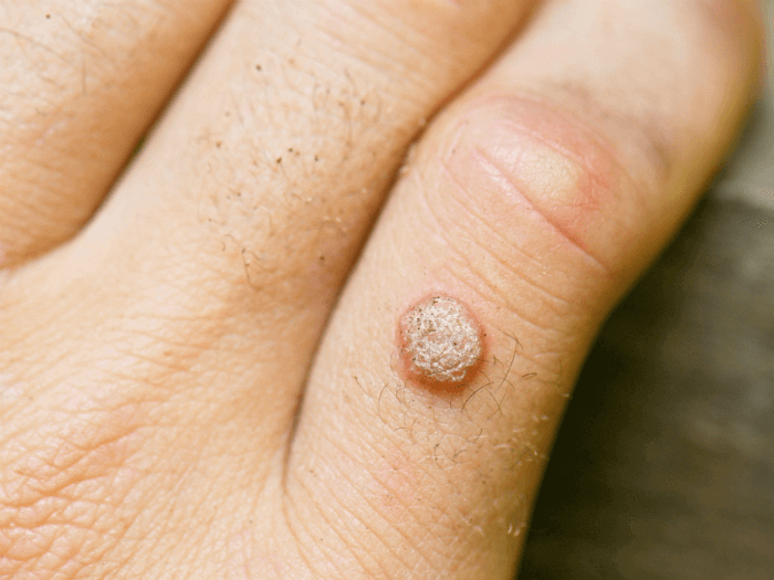 Warts