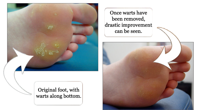 Warts removal