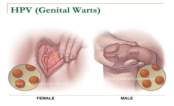 genital warts