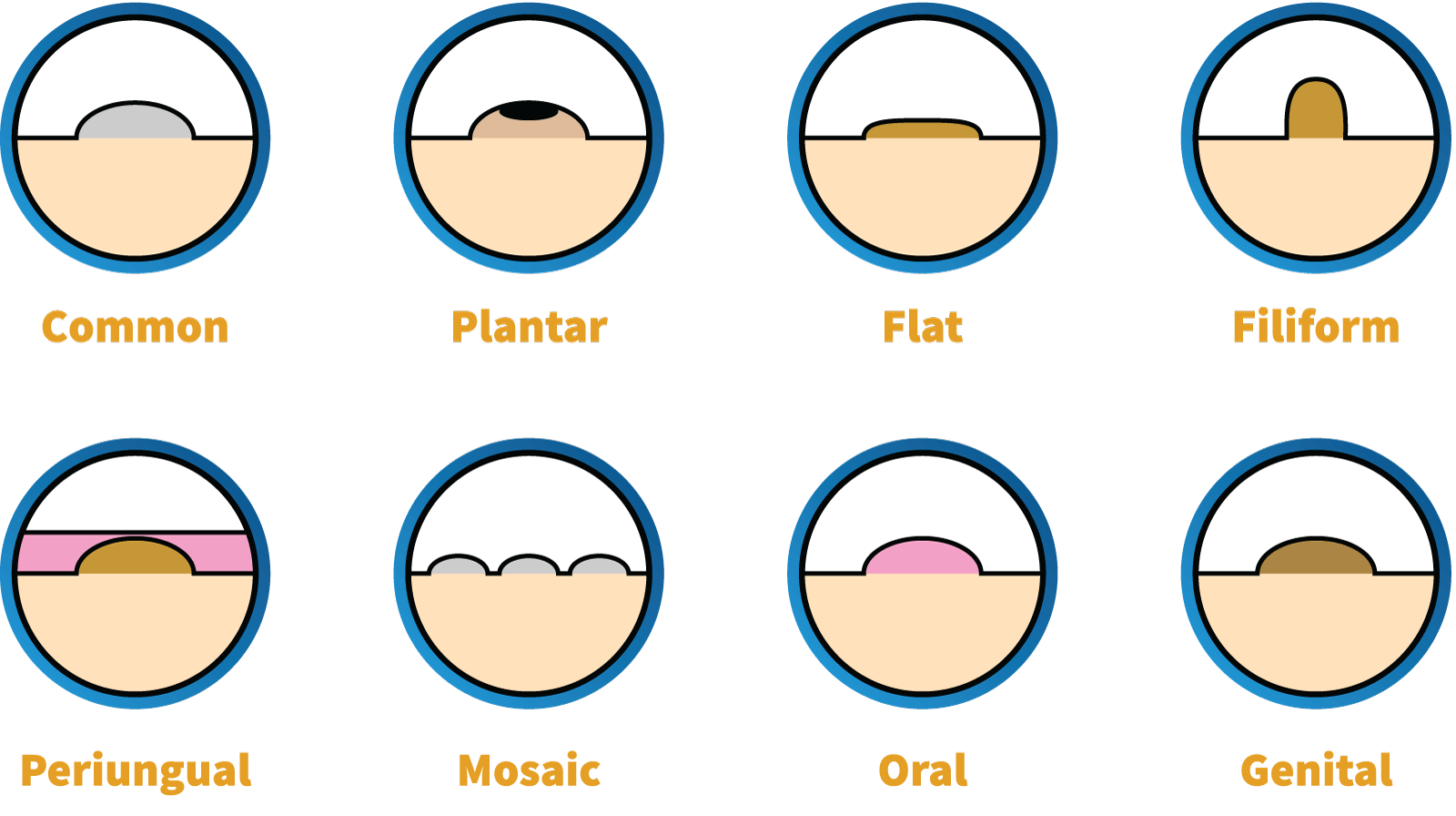 types of warts