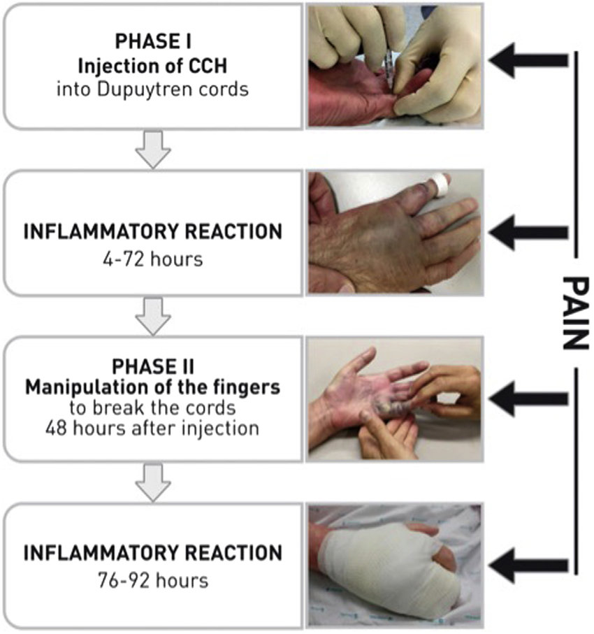 Dupuytren's contracture treatment