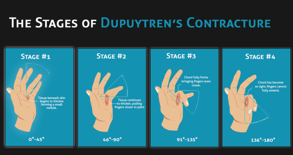 Stages of Dupuytren’s contracture