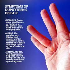 Symptoms of Dupuytren’s contracture