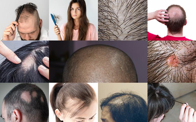 Types of hair loss