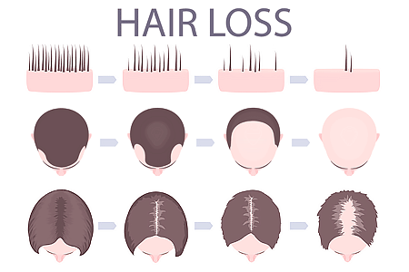 hereditary-hair-loss