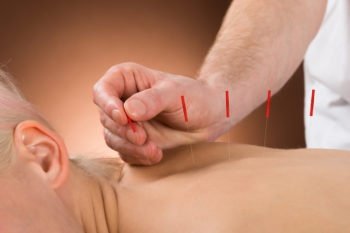 Acupuncture for PTSD