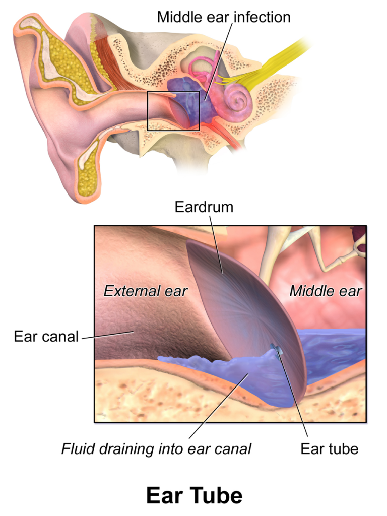 Ear Tube