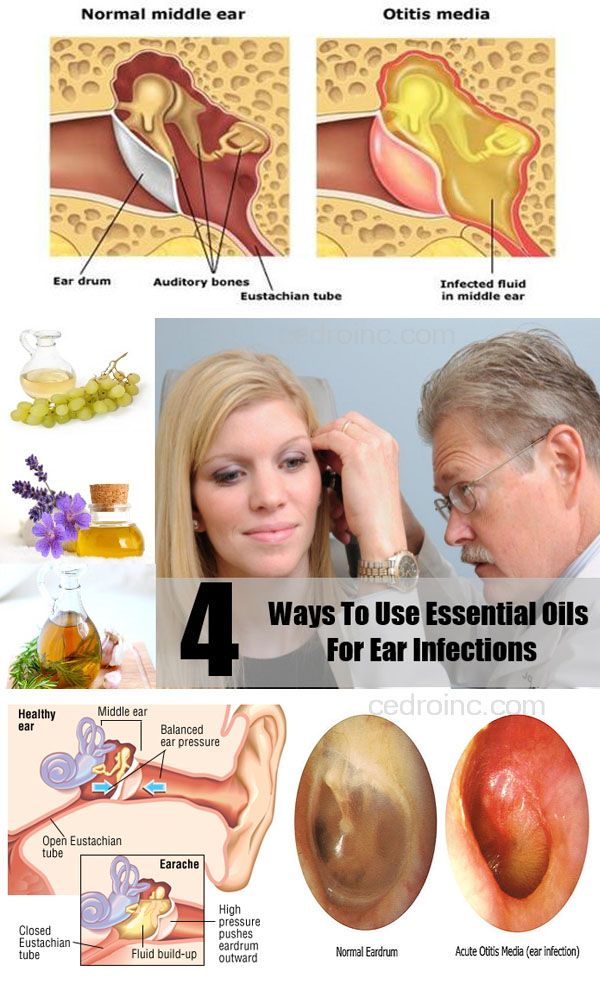 Herbal treatment for otitis