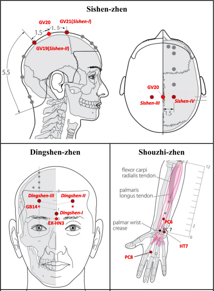 Acupuncture