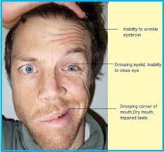 Bell's Palsy