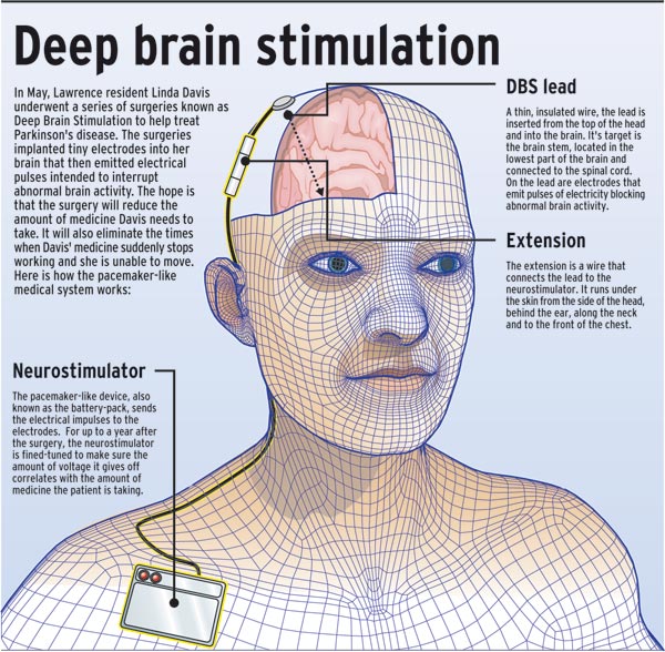 DBS - Deep-Brain-Stimulation - Surgical Treatment