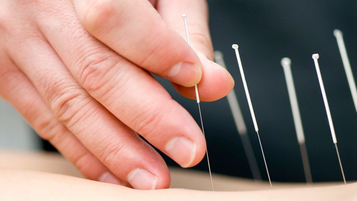 MS - Acupuncture