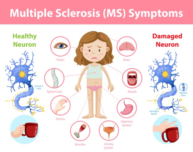 MS - symptoms in women