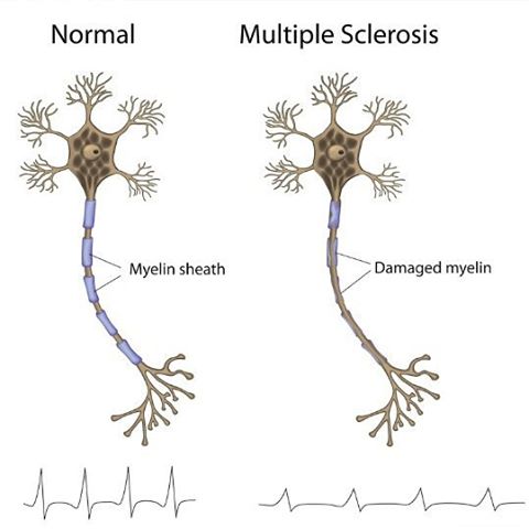What is multiple sclerosis