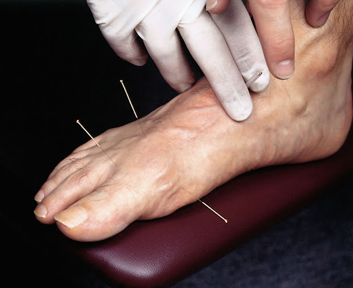 Acupuncture for heel spurs