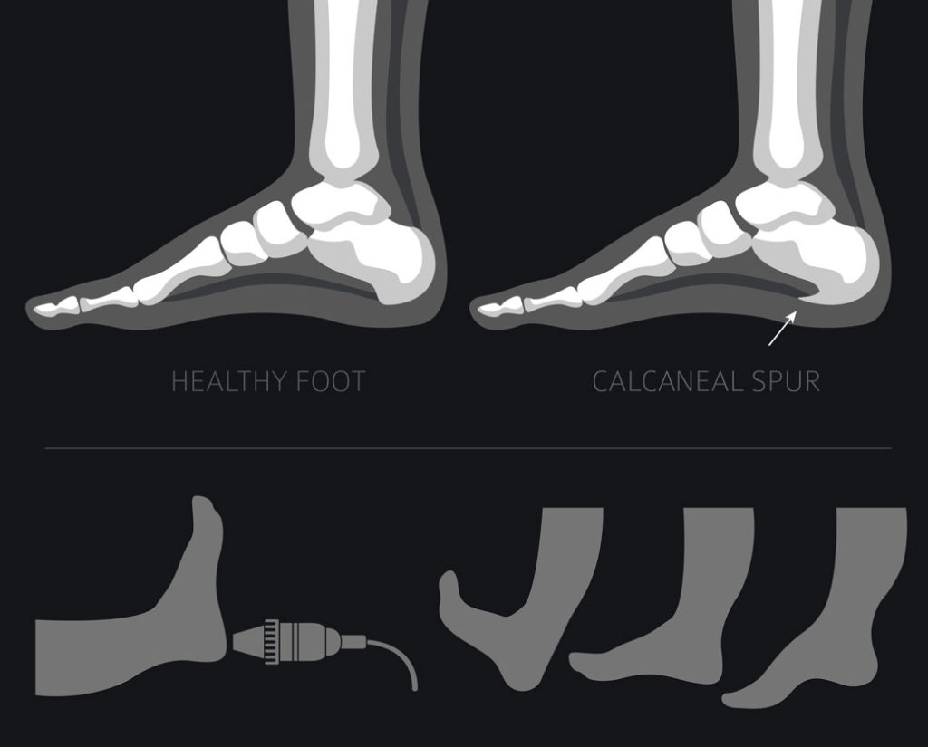 Treatment for Heel Spurs - Philadelphia Holistic Clinic - Dr. Tsan ...