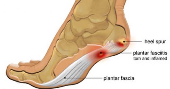 Heel spur vs plantar fasciitis