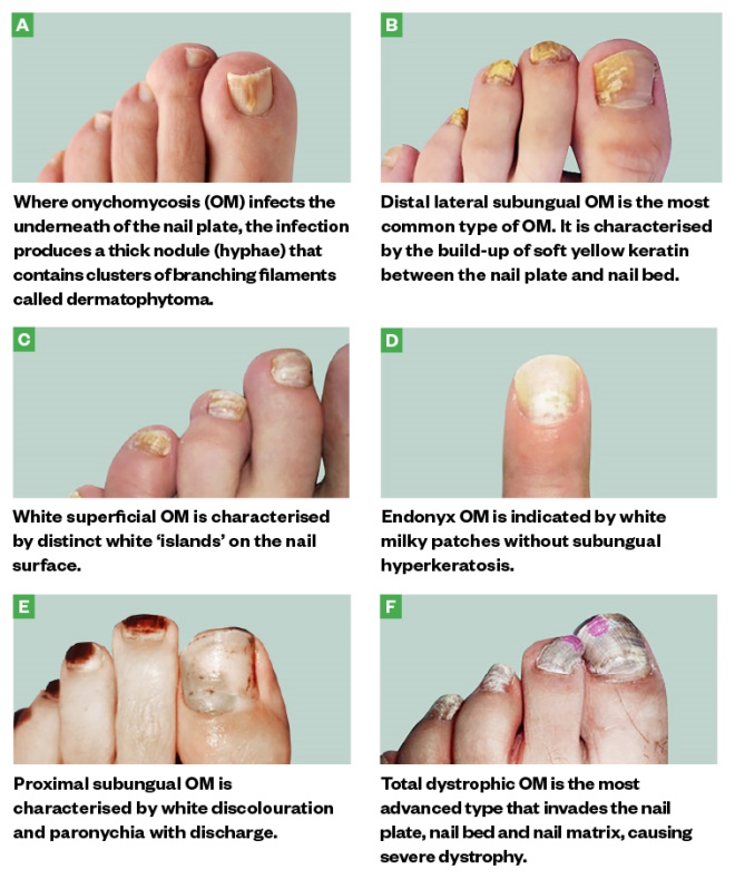 Treatment for Toenails Fungus Philadelphia Holistic Clinic Dr. Tsan & Co