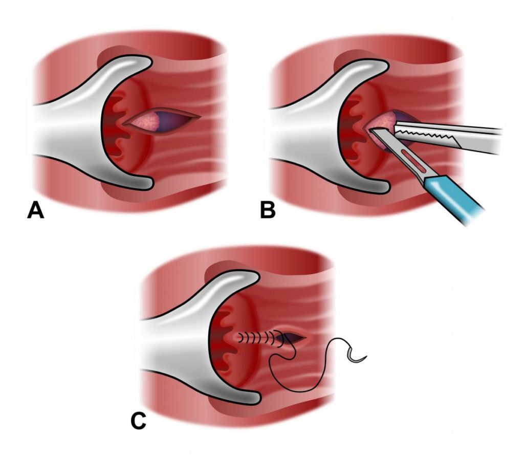 anal fissure surgery