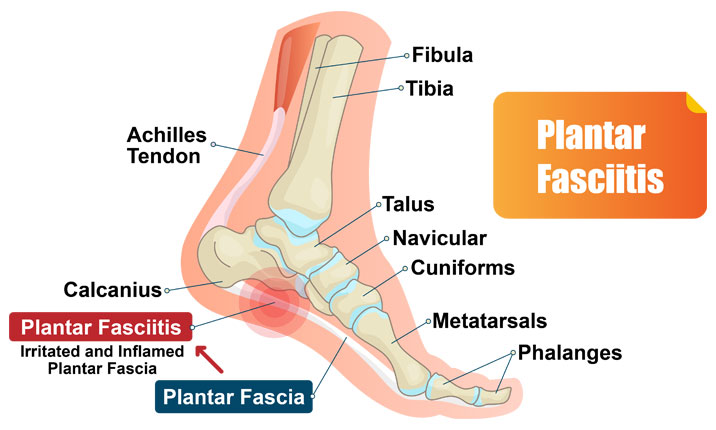 causes of calcaneal pain