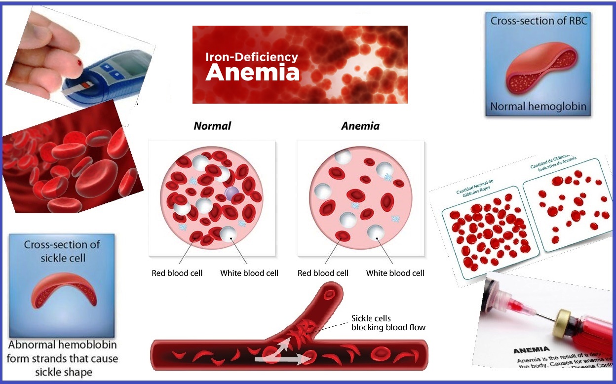 Anemia Homeopathic Treatment