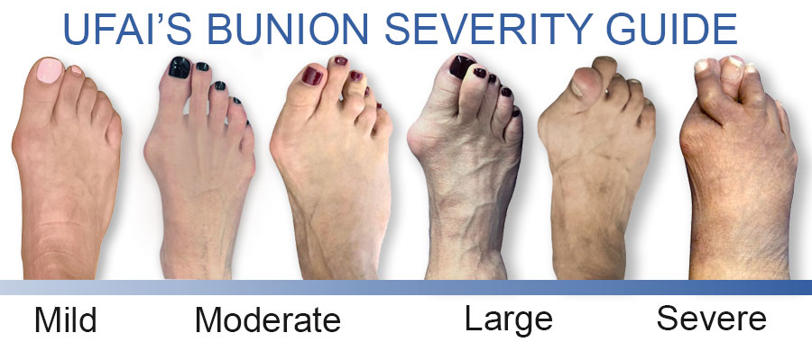 Bunion Serverity Guide