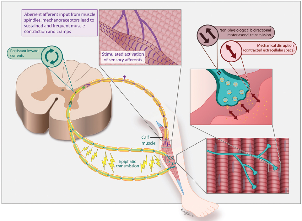 Mechanism of leg cramps