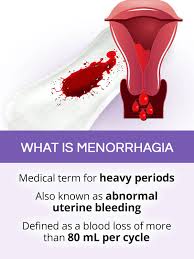 Menorrhagia