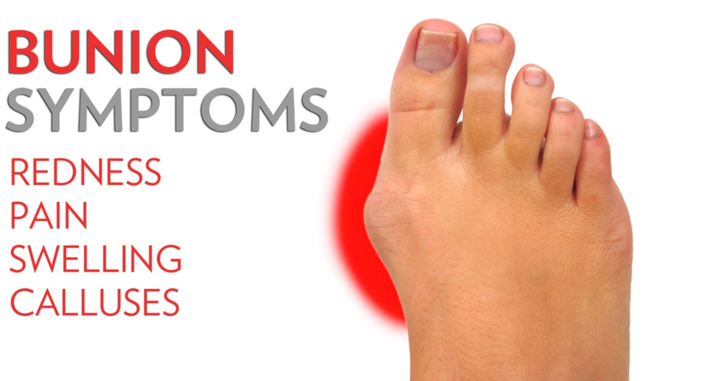 bunion symptoms