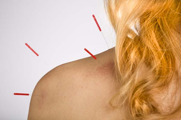 Acupuncture treatment for rotator cuff injury