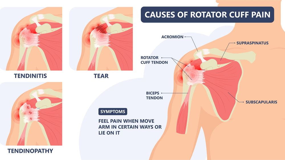 Causes of shoulder pain