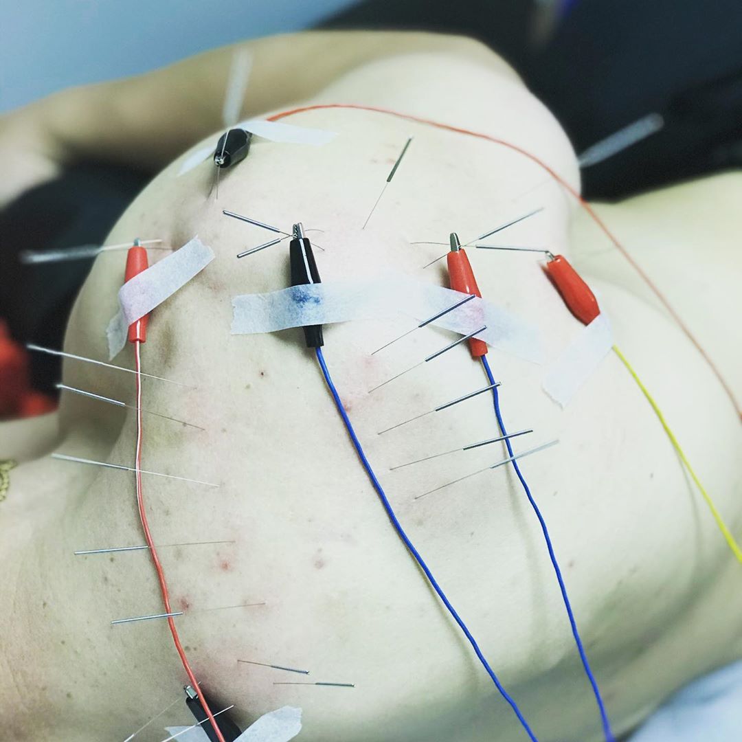 Electric acupuncture