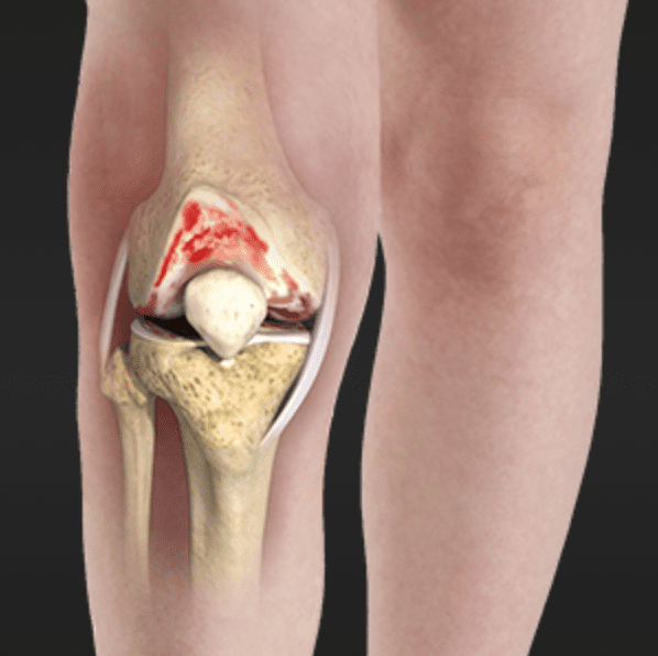 Knee Osteoarthritis