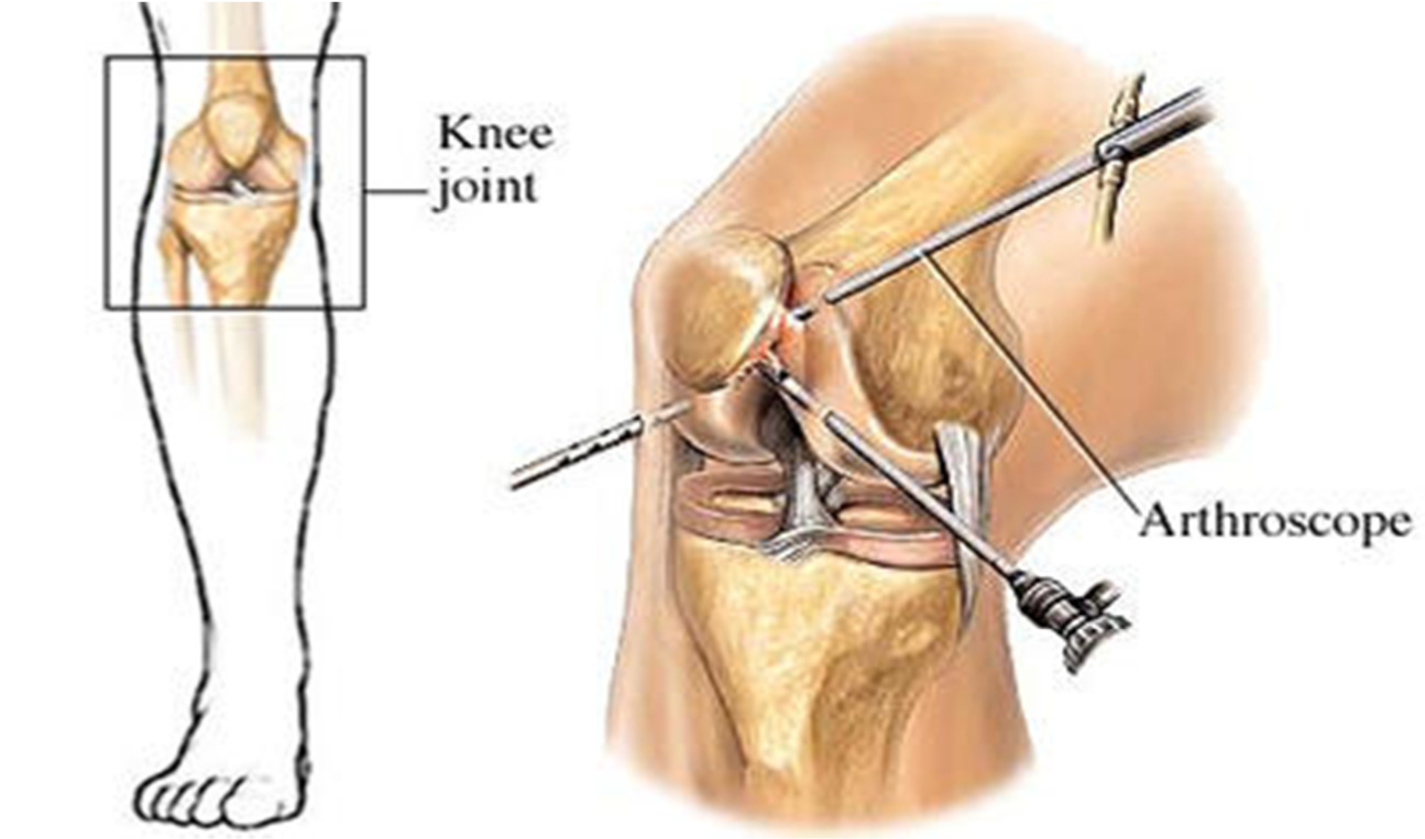 Surgical knee pain treatment