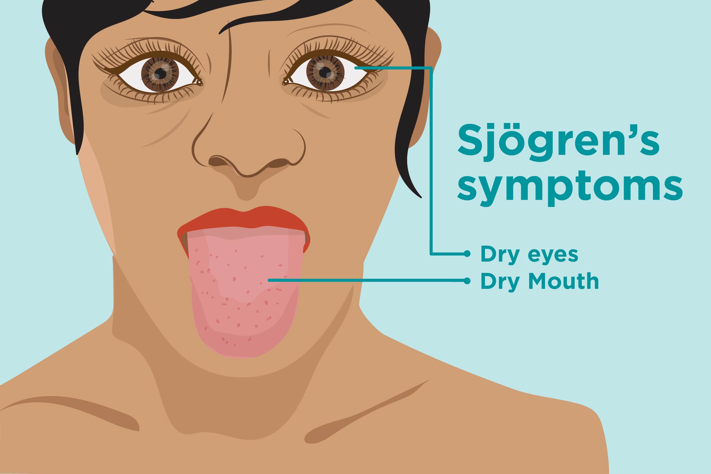 Sjogren syndrome treatment