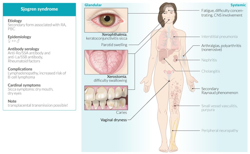 Sjogren's syndrome treatment